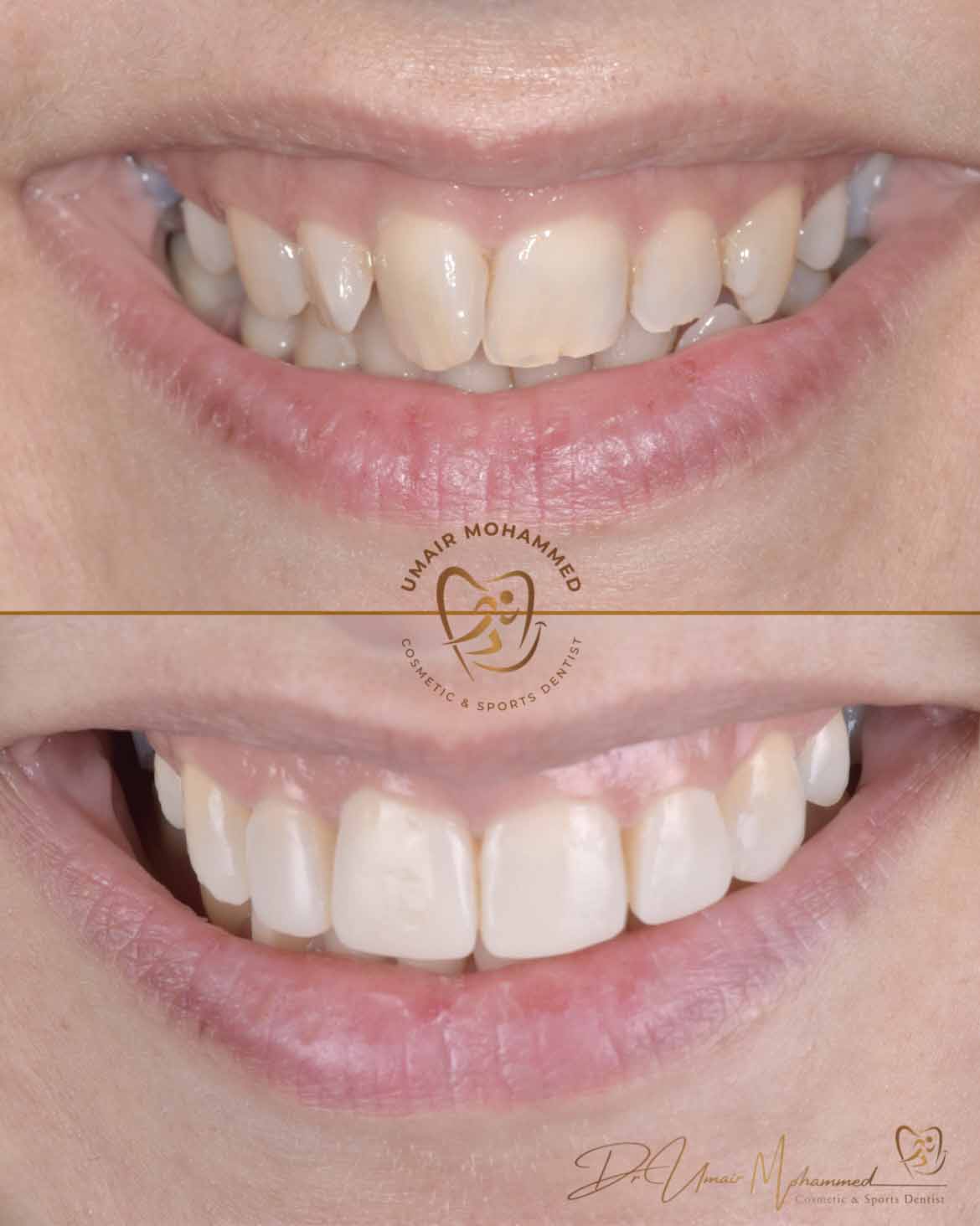 Before and After Patient Teeth 7