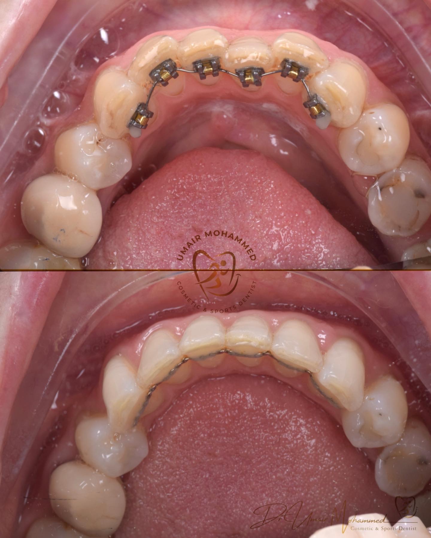 Before and After Patient Teeth 59