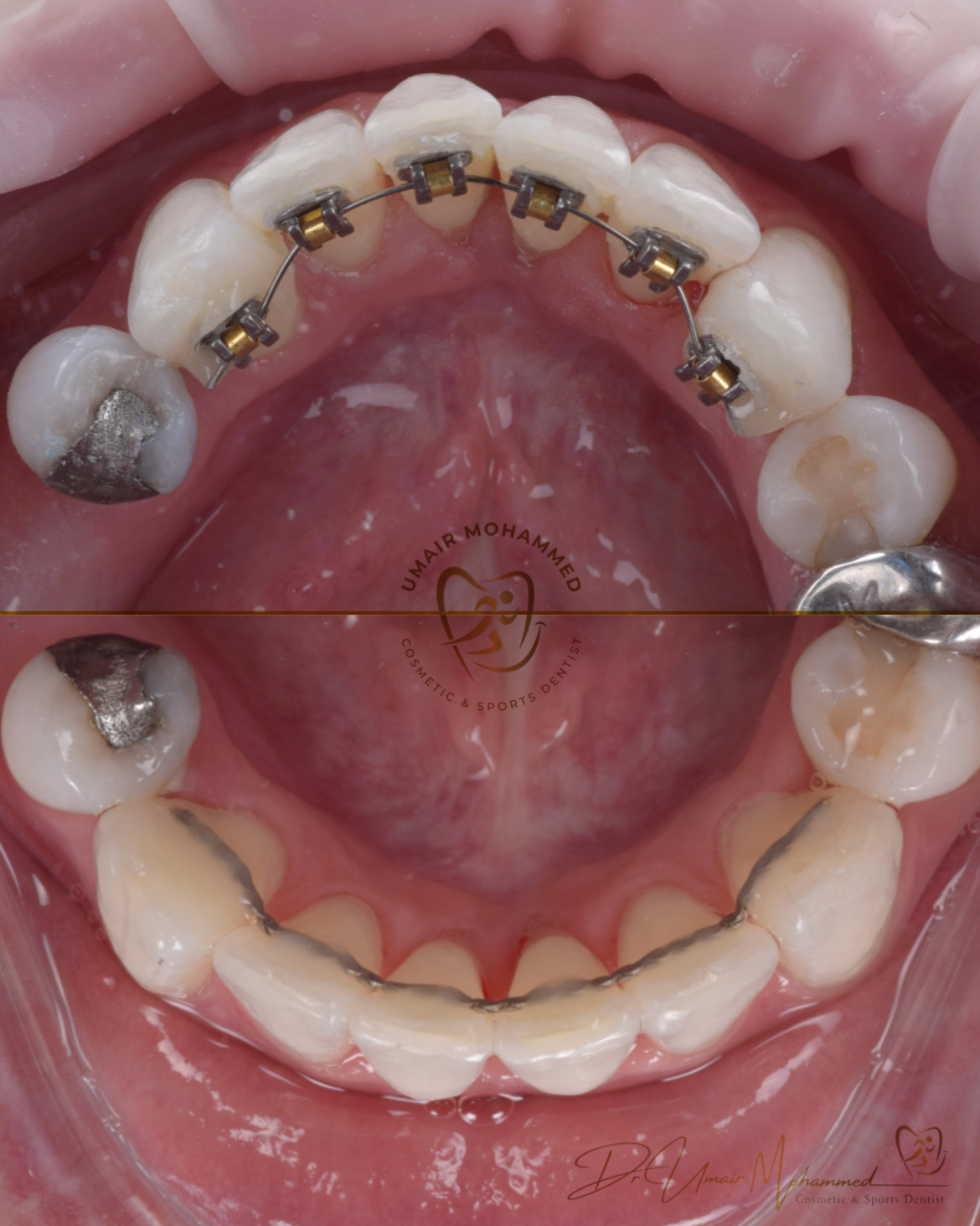 Before and After Patient Teeth 60
