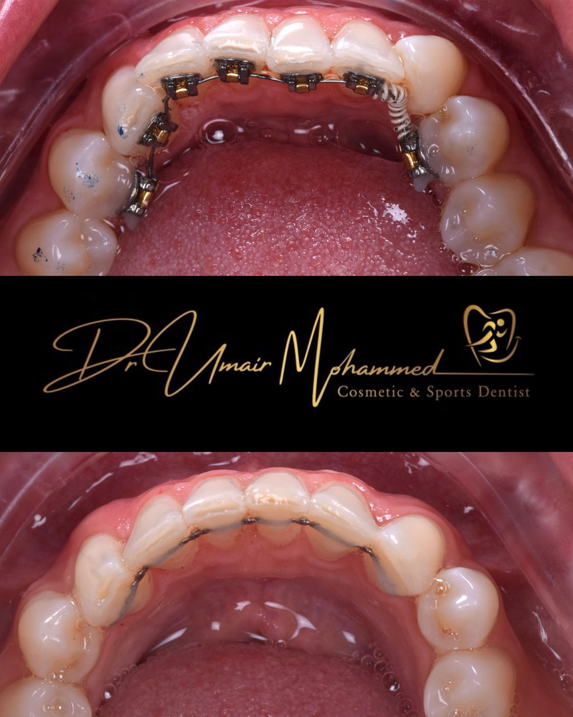 Before and After Patient Teeth 61