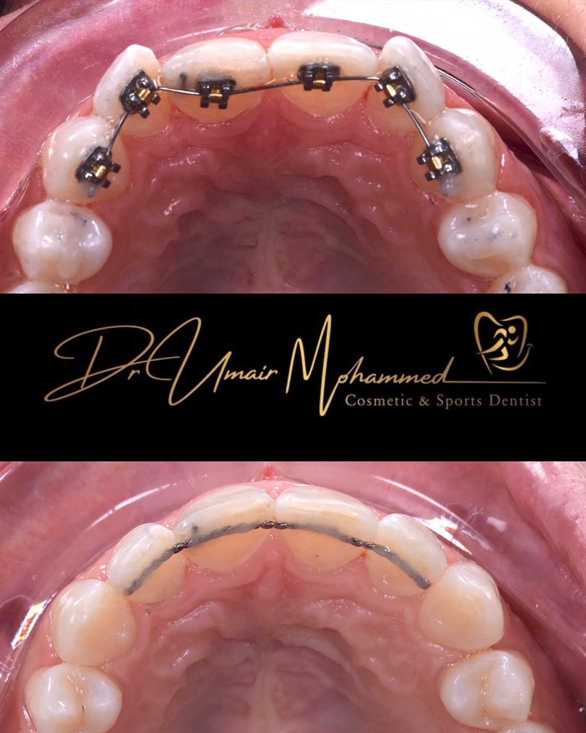 Before and After Patient Teeth 62