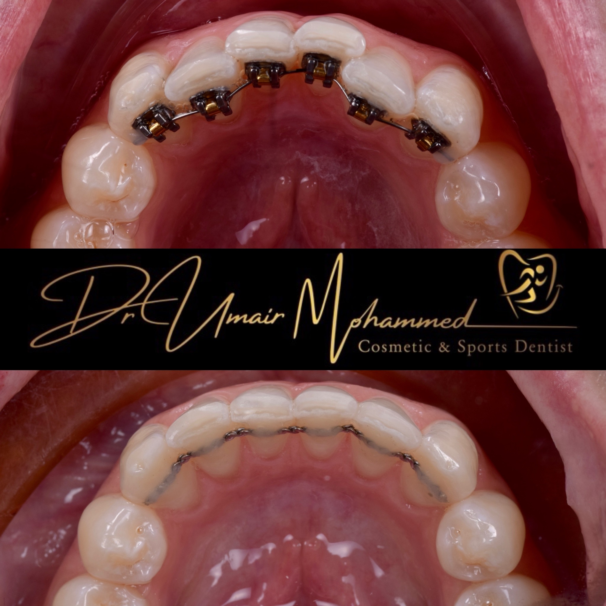 Before and After Patient Teeth 63