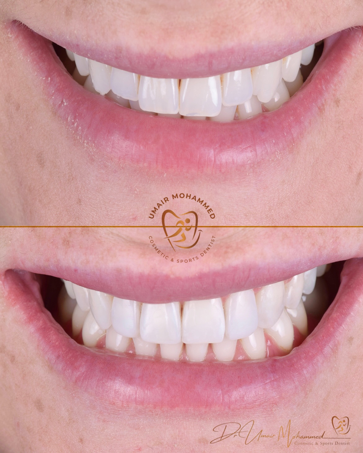 Before and After Patient Teeth 31