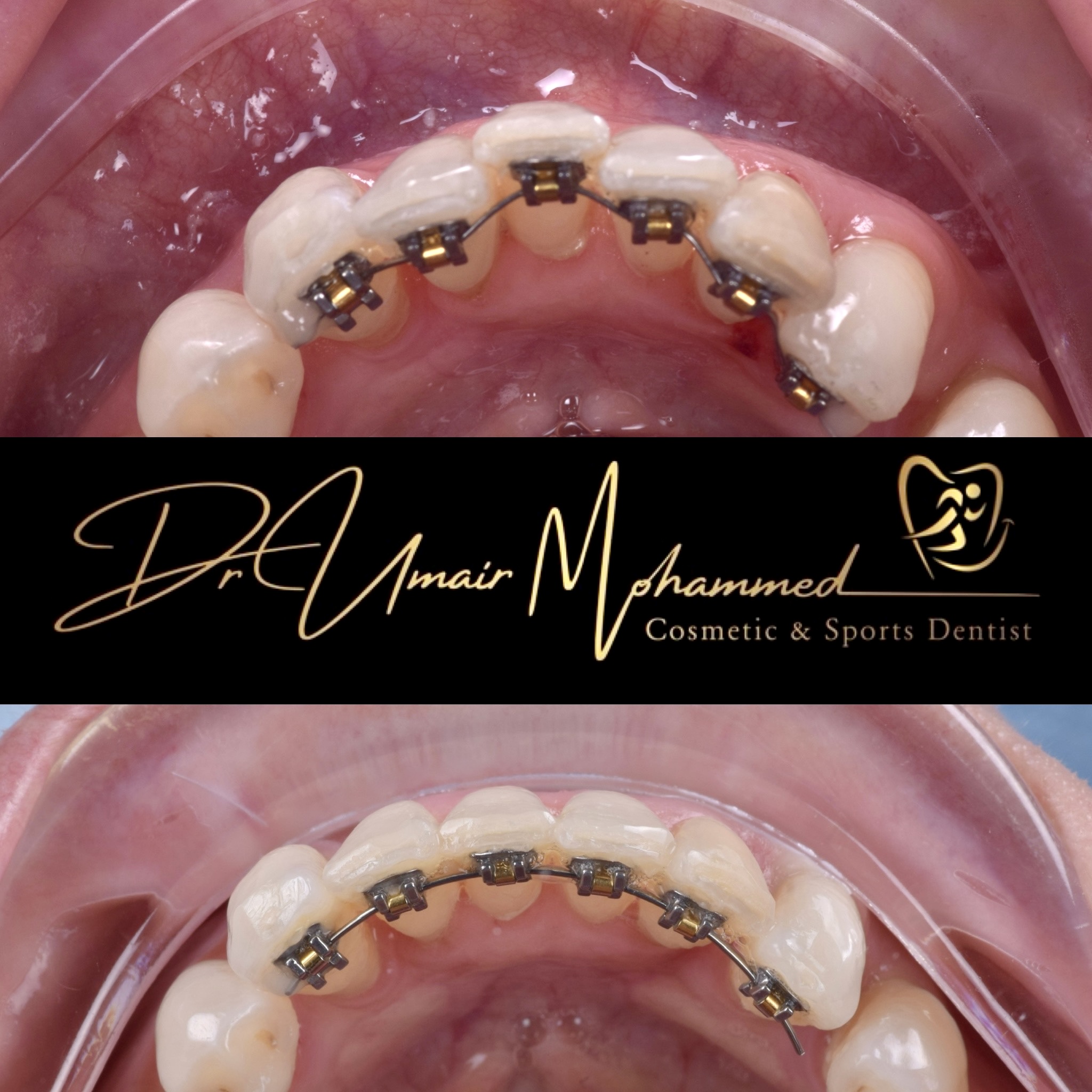 Before and After Patient Teeth 64