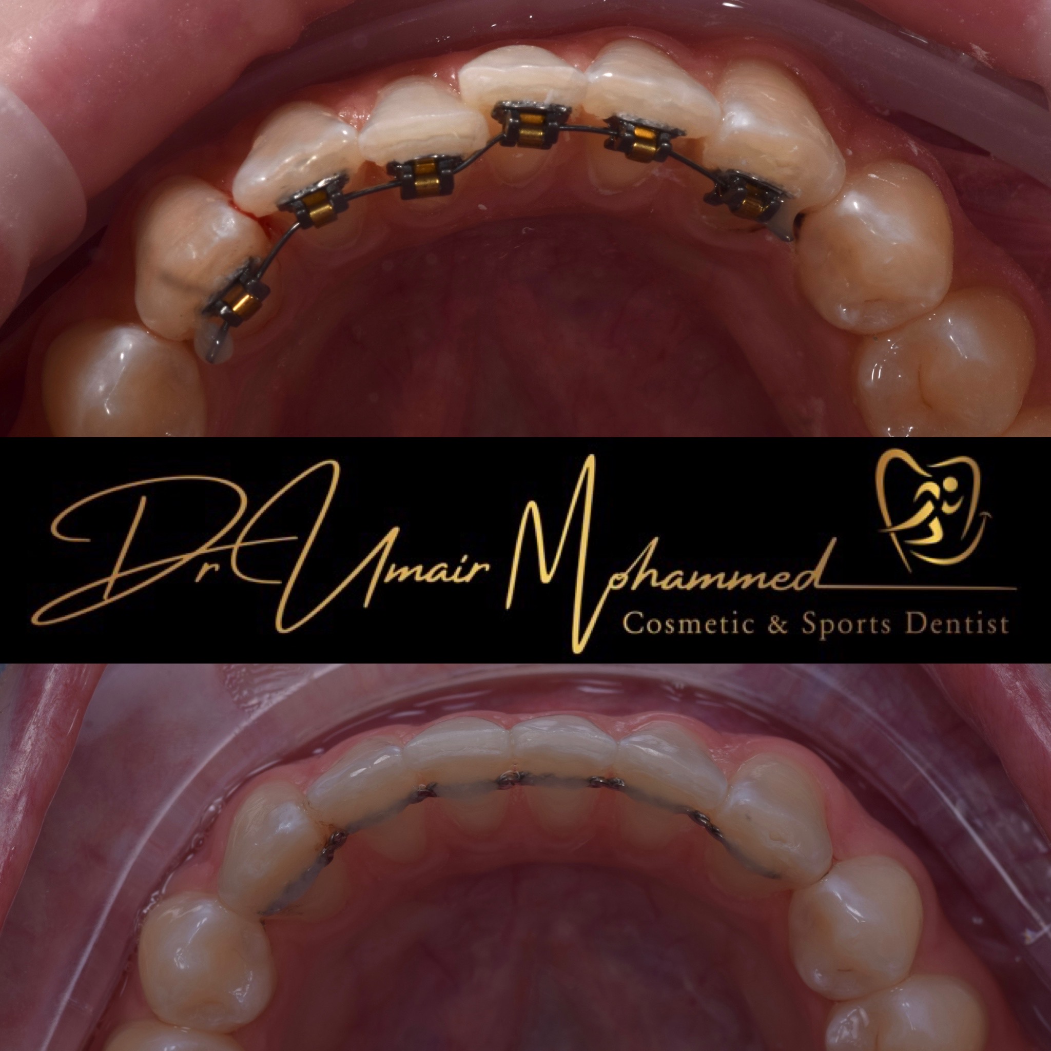 Before and After Patient Teeth 65