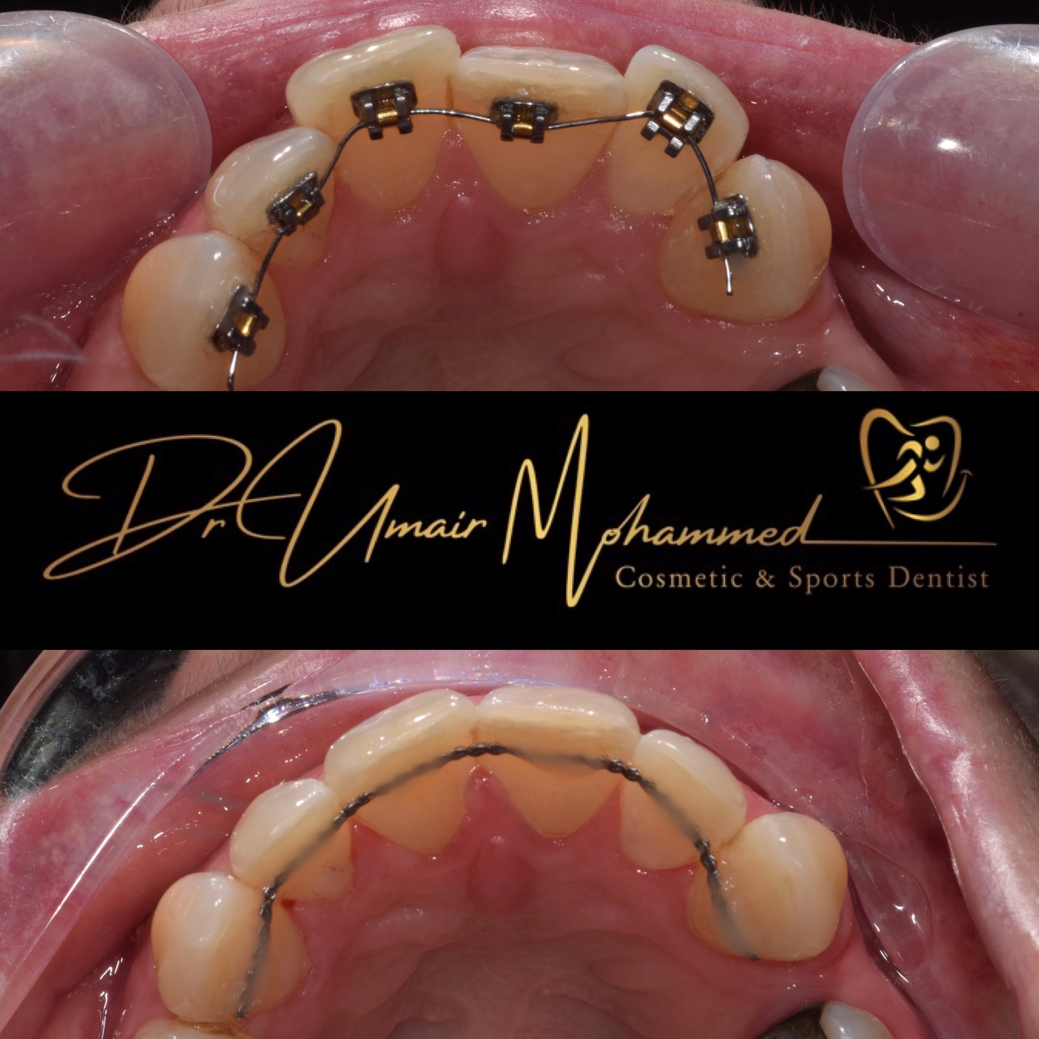 Before and After Patient Teeth 66