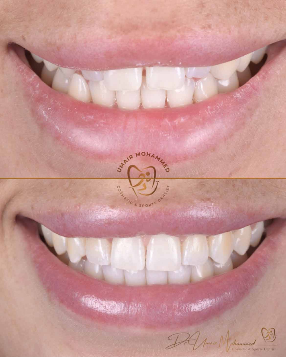 Before and After Patient Teeth 1