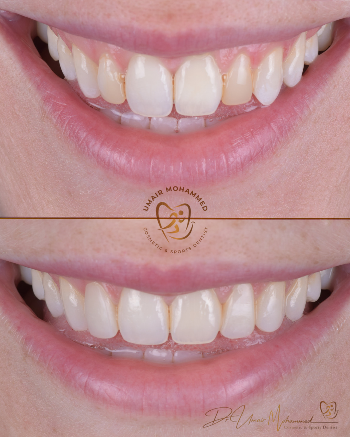 Before and After Patient Teeth 33