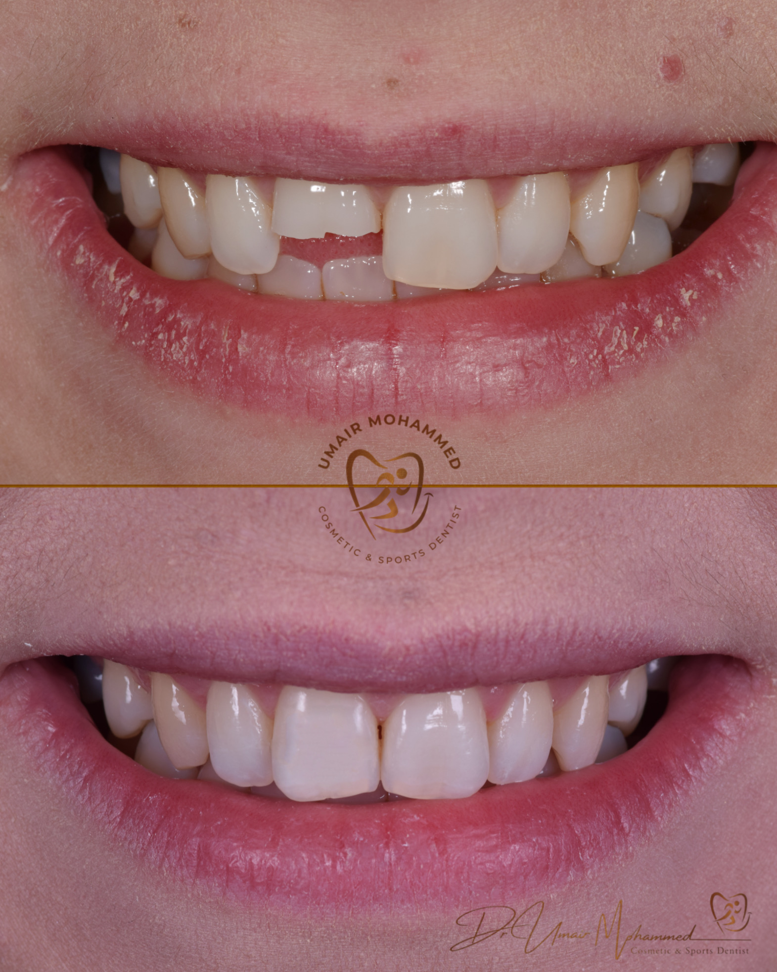 Before and After Patient Teeth 34