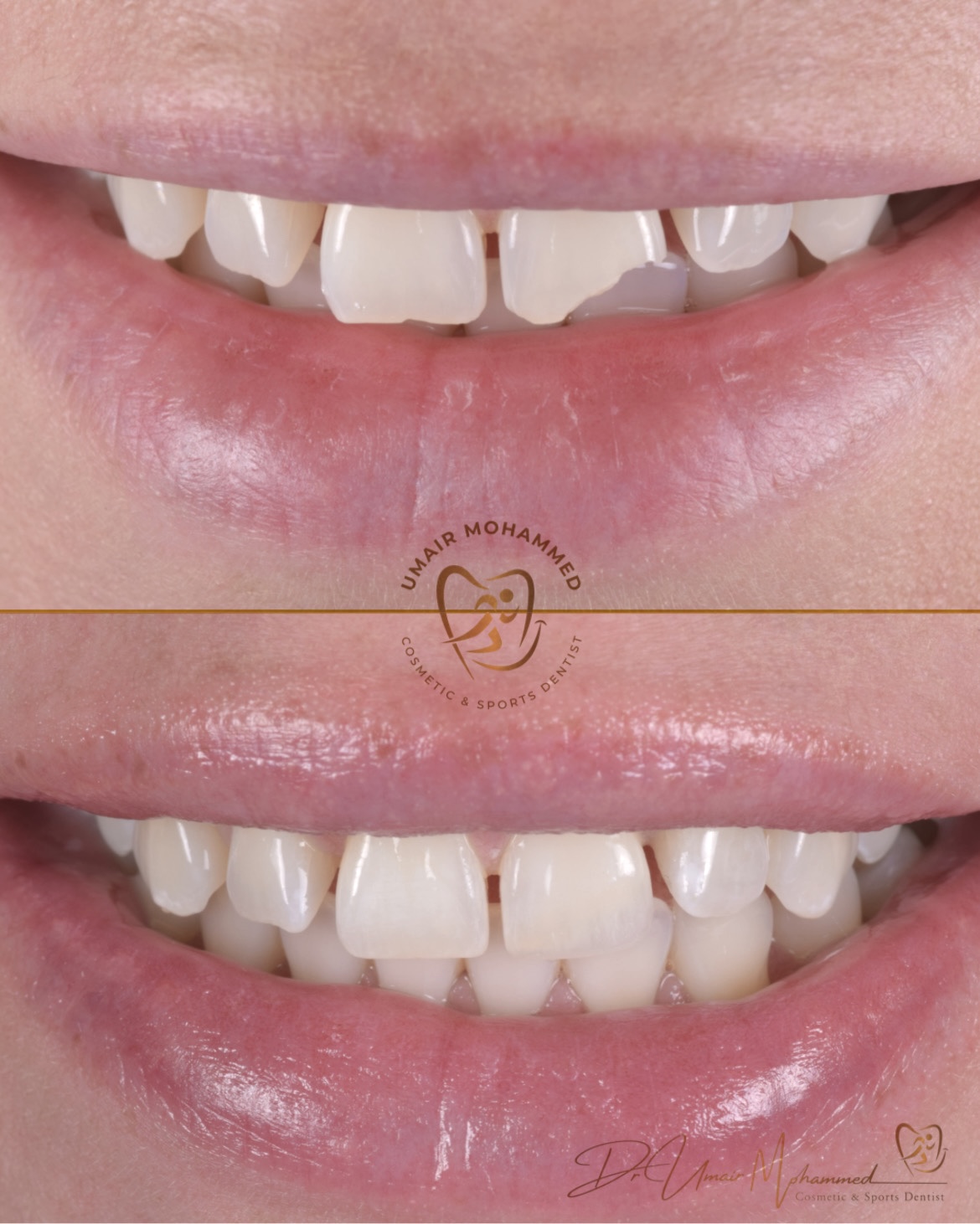 Before and After Patient Teeth 36